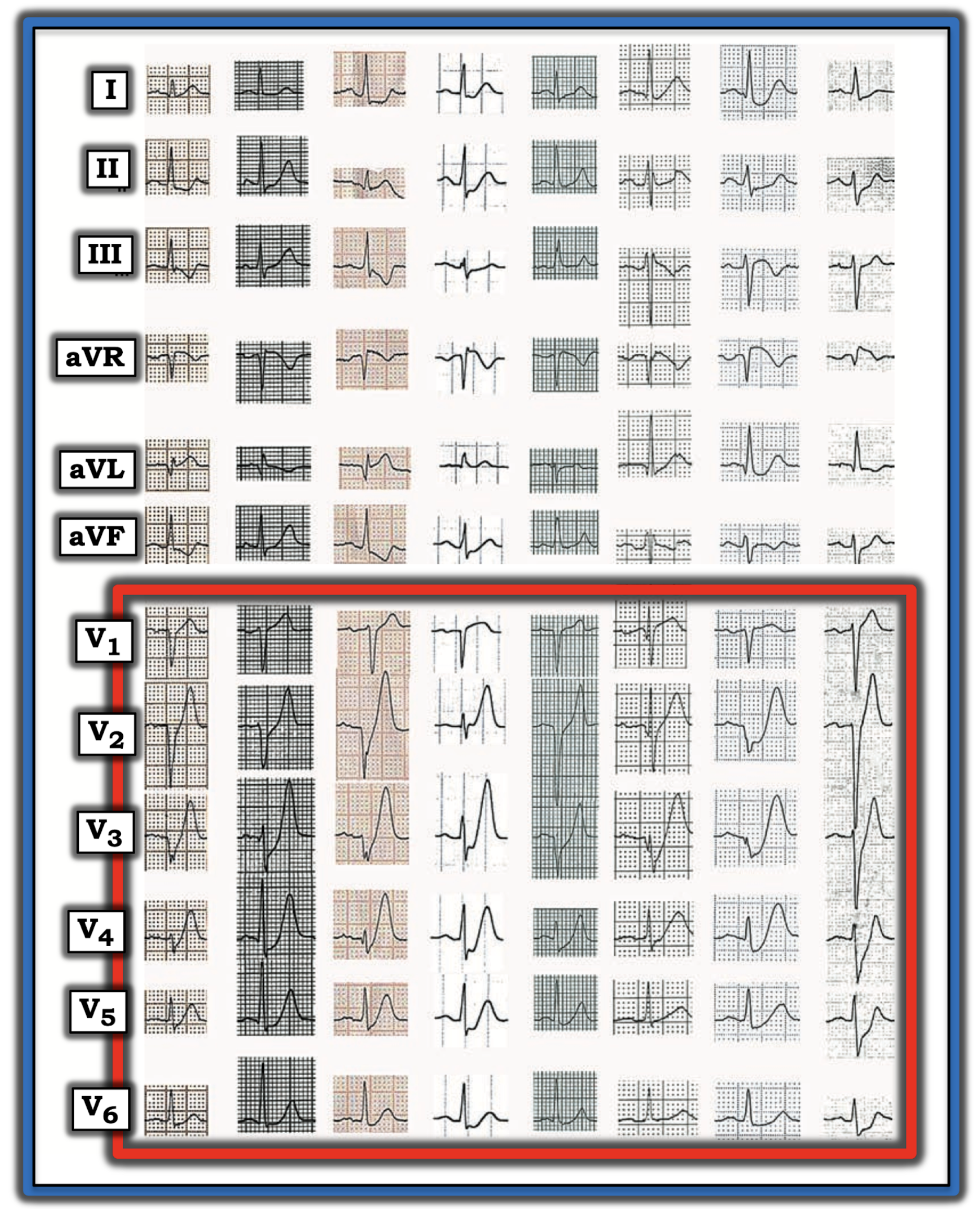 Hyperacute T Waves De Winter T Waves Ecg Guru Instructor Resources 